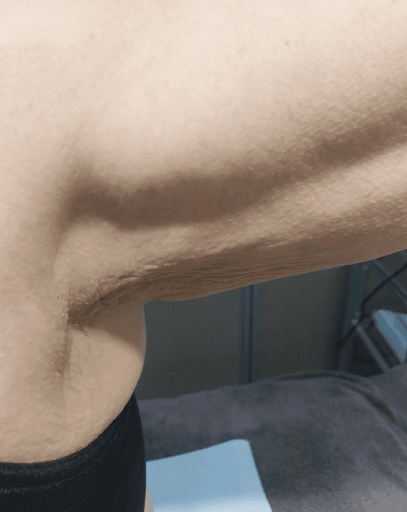 Dopo - Ascella/Braccio