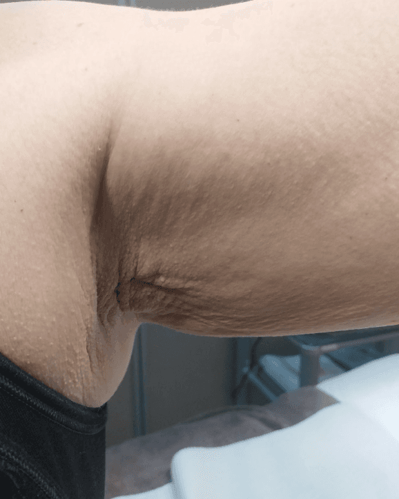 Prima - Ascella/Braccio